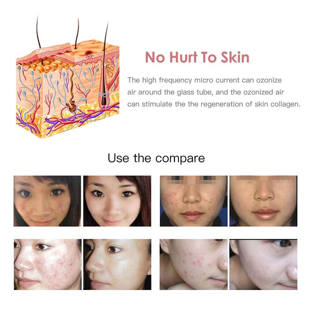 8 images of a model stating that the High Frequency Wand causes no harm to the skin
